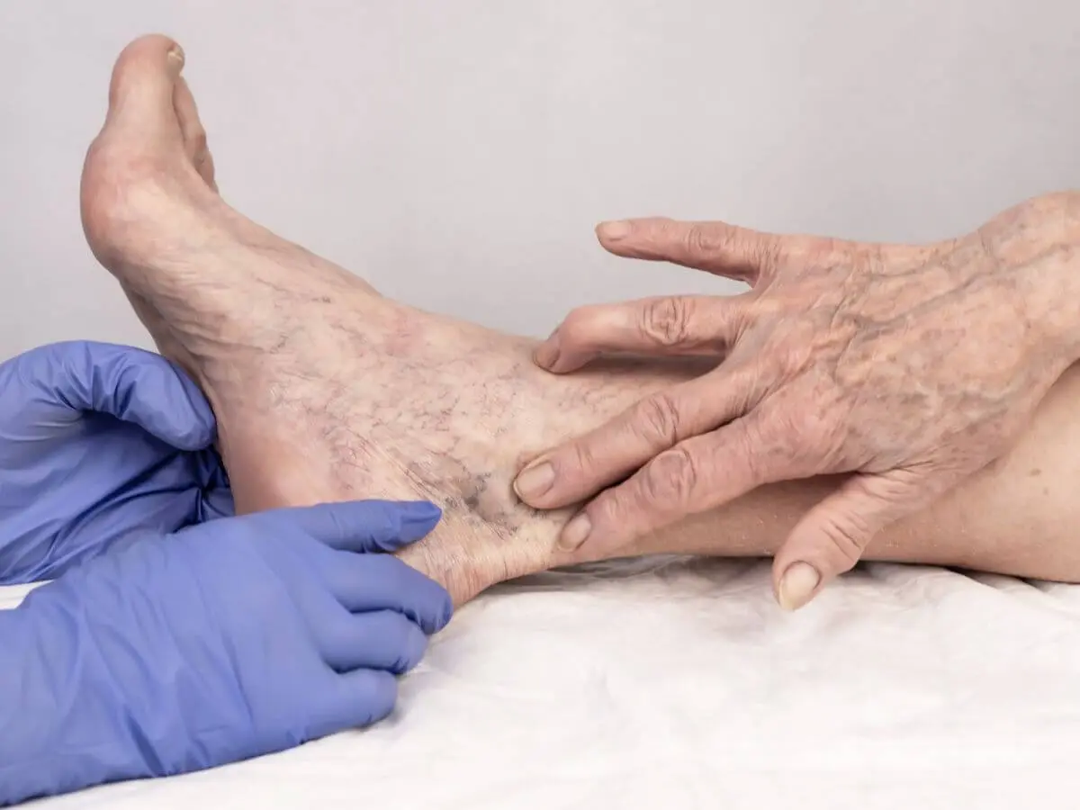 feridas nas pernas feridas nas pernas