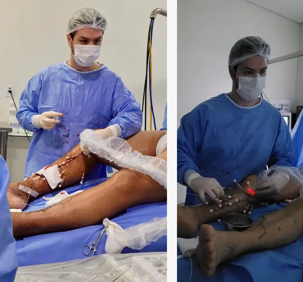 termoablação de safena - dr romulo bizare em procedimento termoablação de safena - dr romulo bizare em procedimento