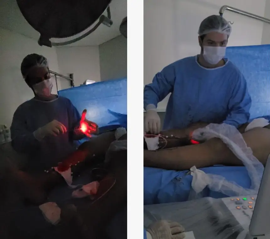 termoablação de safena - dr romulo bizare em procedimento termoablação de safena - dr romulo bizare em procedimento
