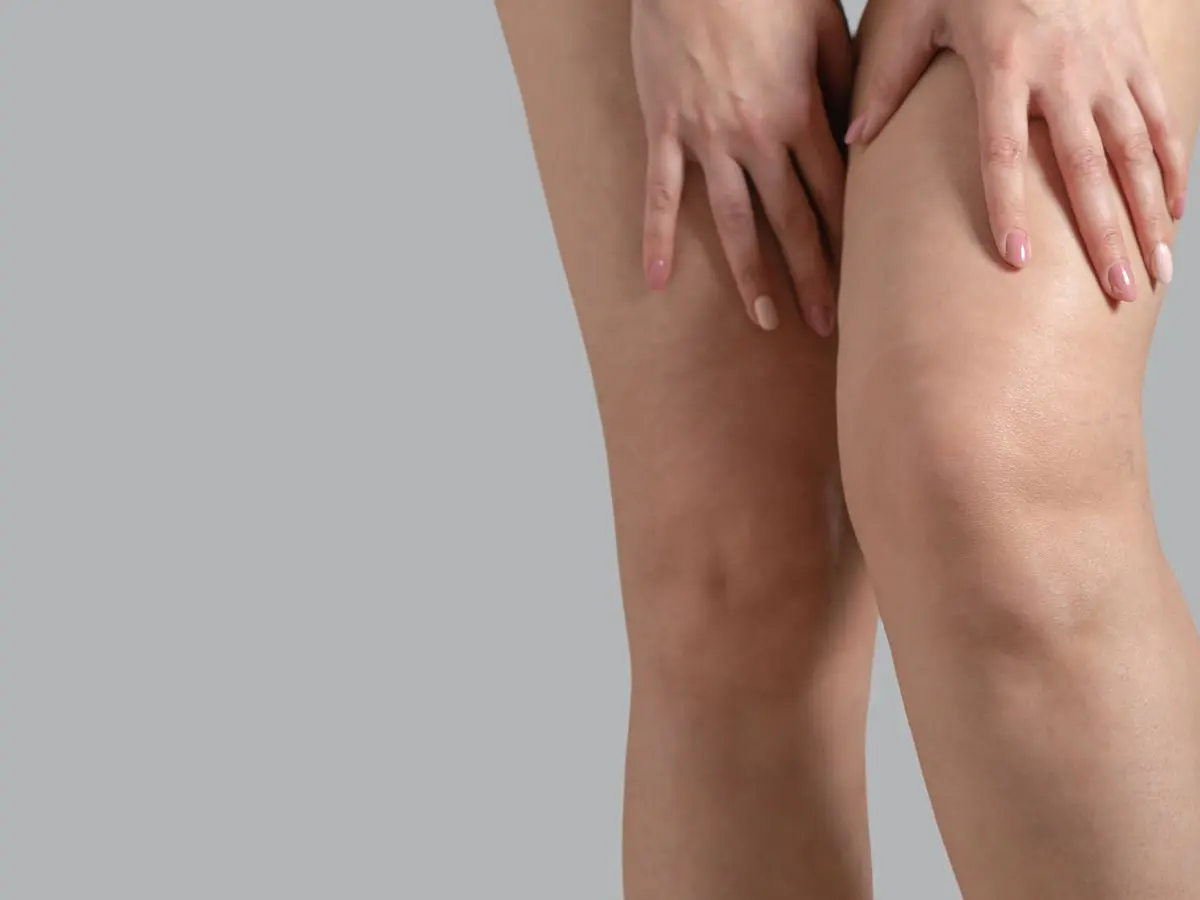 tratamento de lipedema em marilia