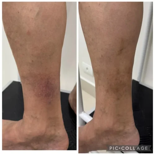 escleroterapia com espuma escleroterapia com espuma