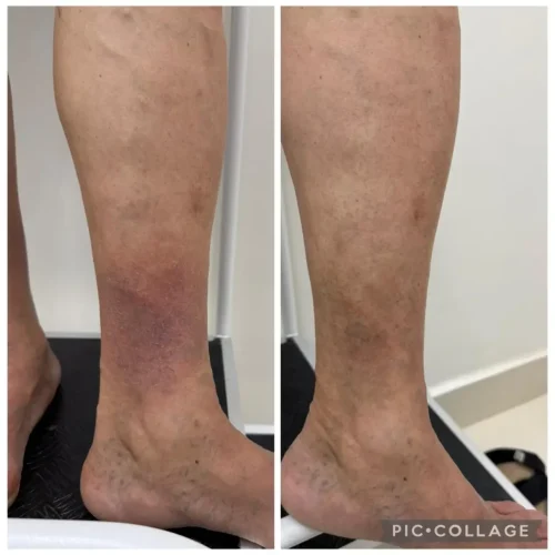escleroterapia de varizes e vasinhos 1 escleroterapia de varizes e vasinhos 1