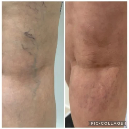 escleroterapia de varizes e vasinhos 2 escleroterapia de varizes e vasinhos 2
