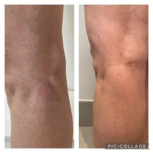 escleroterapia de varizes e vasinhos 8 escleroterapia de varizes e vasinhos 8