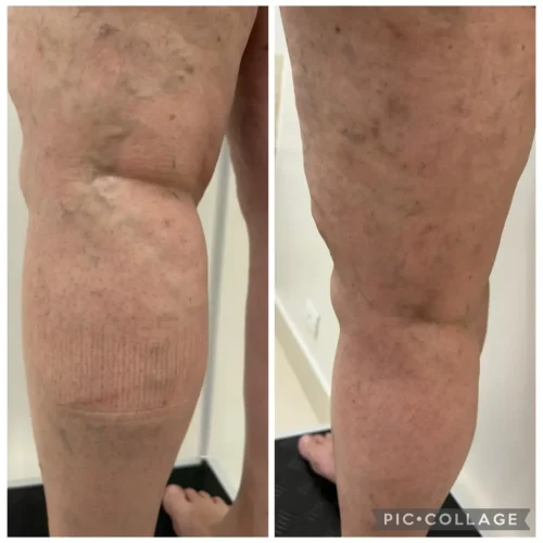 escleroterapia de varizes e vasinhos escleroterapia de varizes e vasinhos