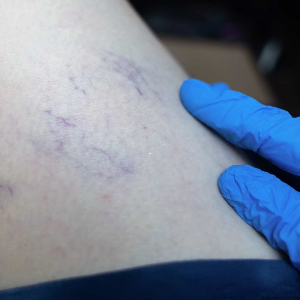 Cirurgião vascular examinando vasinhos e alterações venosas superficiais na perna