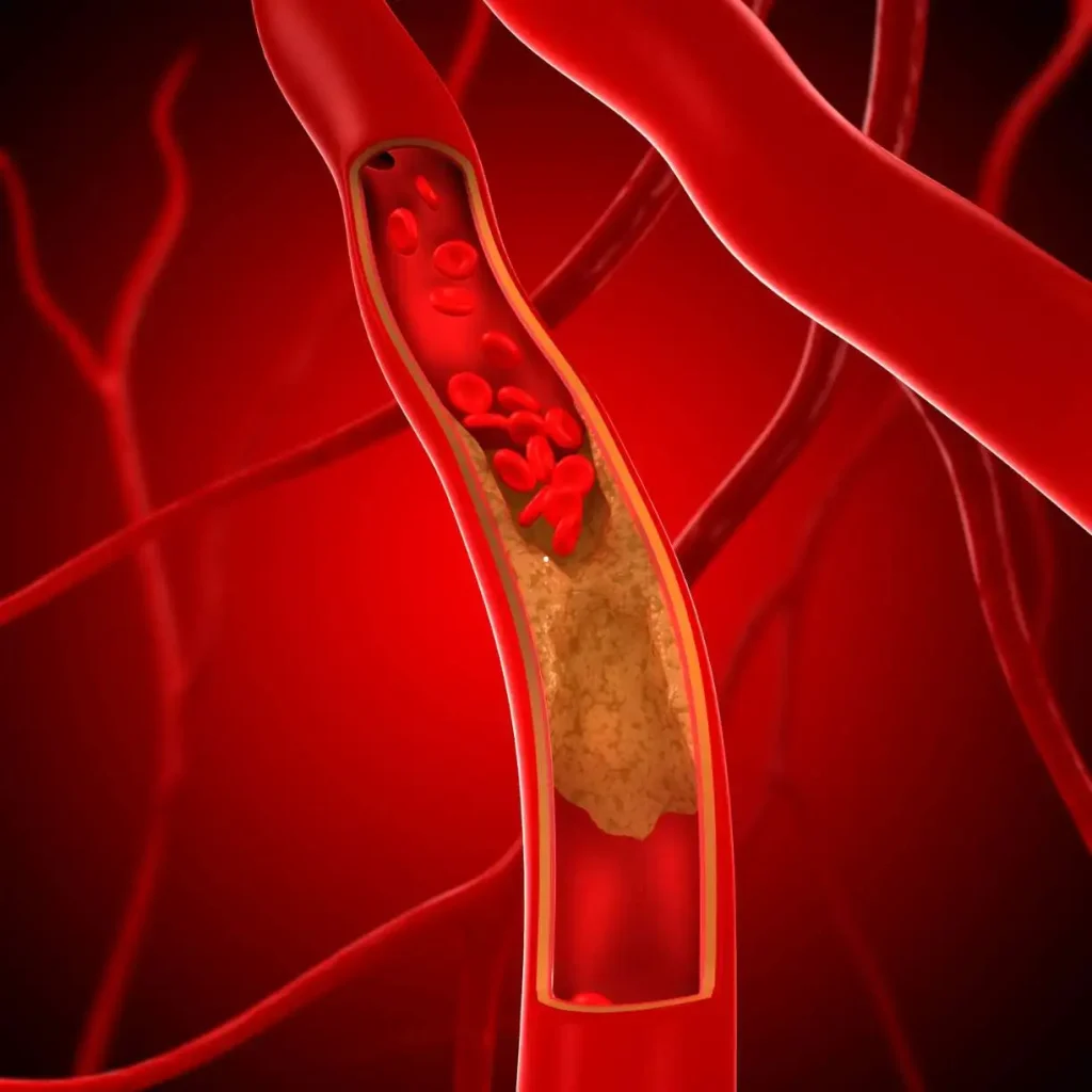 Ilustração médica de uma artéria com acúmulo de placas de gordura bloqueando o fluxo sanguíneo.