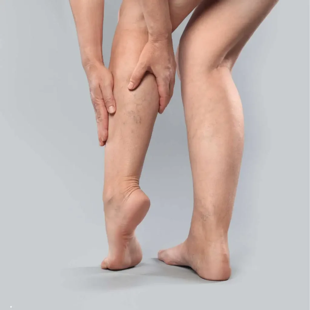 Paciente com varizes e vasinhos aparentes nas pernas buscando diagnóstico com angiologista em Marília.