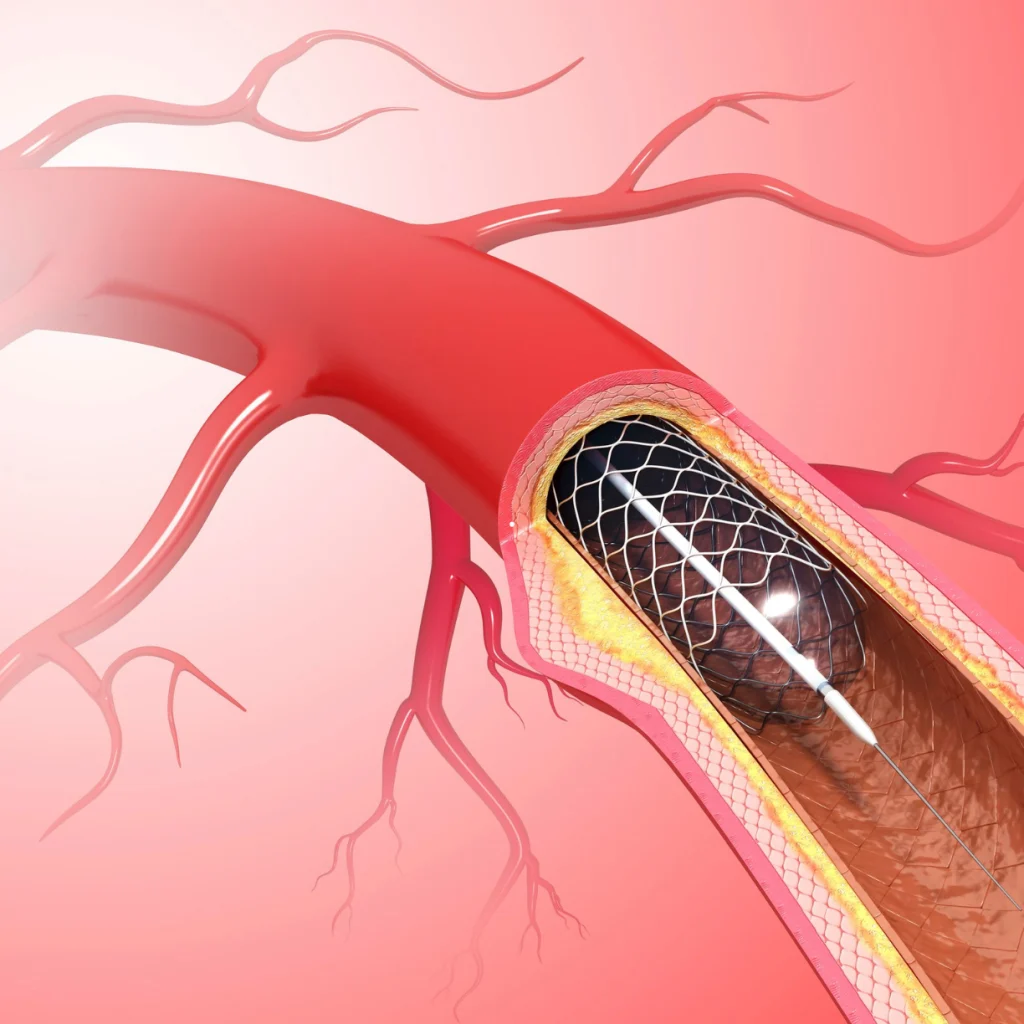 Ilustração 3D de um stent sendo expandido por balão dentro de uma artéria obstruída, representando a ciência da cirurgia endovascular.